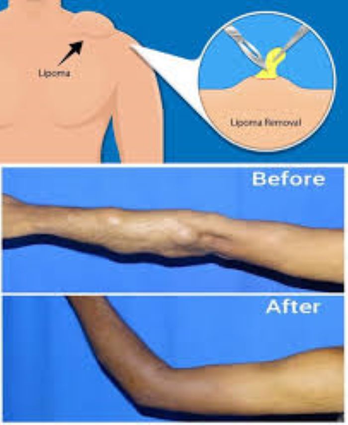 How To Get Lipoma Removal Covered By Insurance?
