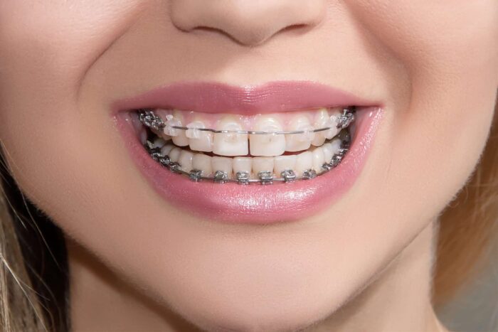 Where Can I Get My Braces Removed Without Insurance? Learn More Here